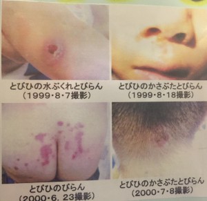 随分前の資料です。こんな感じの症状